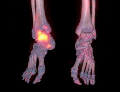Osteoarthritis of the ankle. Combined 3D computed tomography (CT)