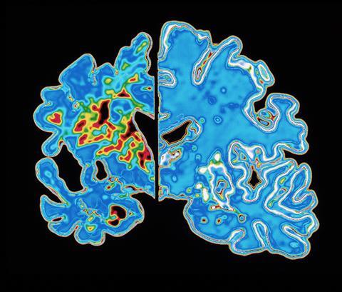 Understanding Alzheimer's - Disease vs normal brain